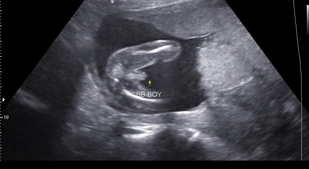Ultrasonidos Del Embarazo 2d 3d 4d Y 5d Hd Little Bellies Ultrasound 2d 3d 4d 5d Hd Pregnancy Spa